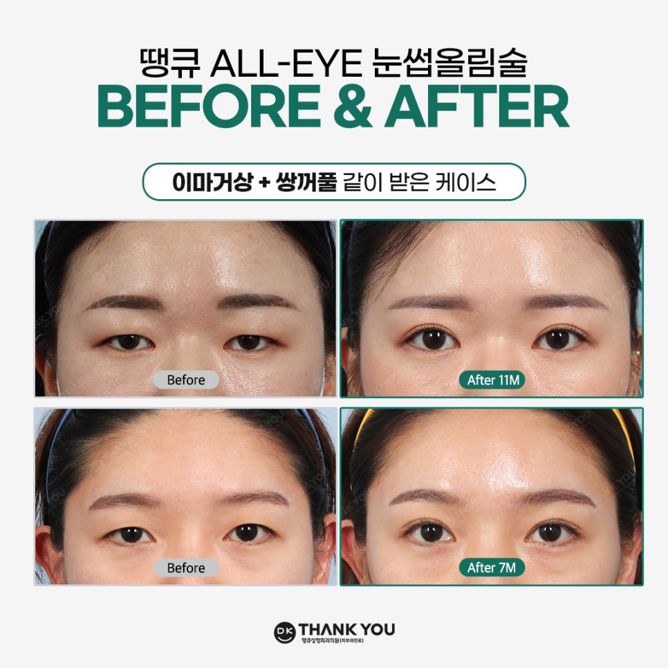 Improving Drooping, Tired-Looking Eyes in One Go with Forehead Lift Surgery! image 15