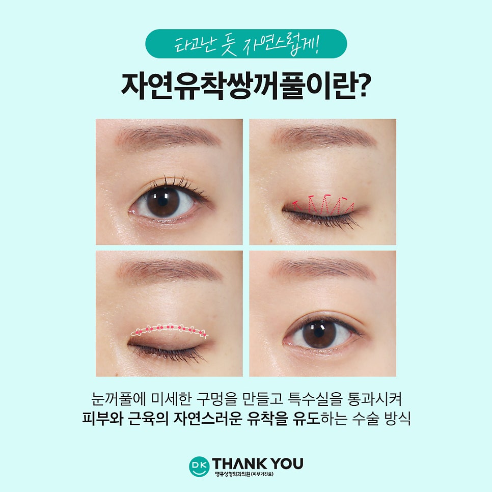 Natural adhesion double eyelid review: Beautiful, naturally-looking lines completed at Thank You! image 2