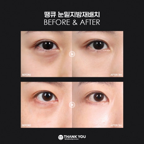 눈밑지방재배치잘하는병원 땡큐만의 특별한 노하우! 관련 이미지 7