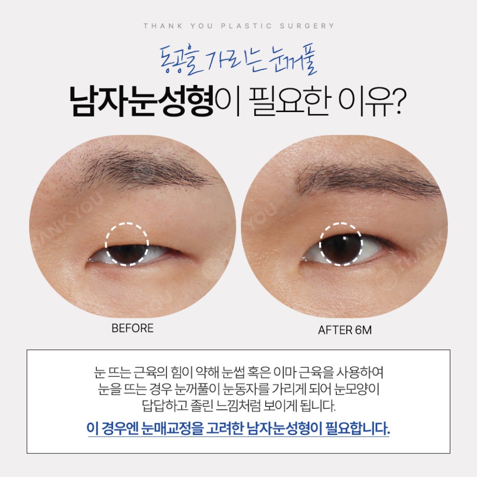 땡큐 남자눈성형 솔루션 (ft. 남자비절개 눈매교정 전후) 관련 이미지 5