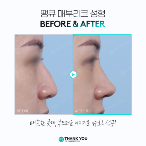 Hump Nose Improvement: Personalized Surgery Is Important! image 11