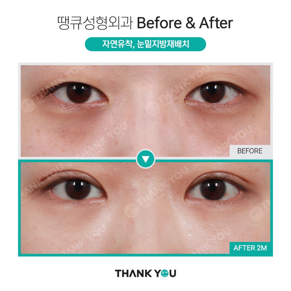눈밑 필러 넣었는데 눈밑지방재배치 가능할까요? (이호준 칼럼) 관련 이미지 14