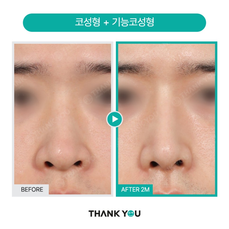 신논현역 성형외과, 남자 휜코성형, 매부리코 성공 포인트는? 관련 이미지 14