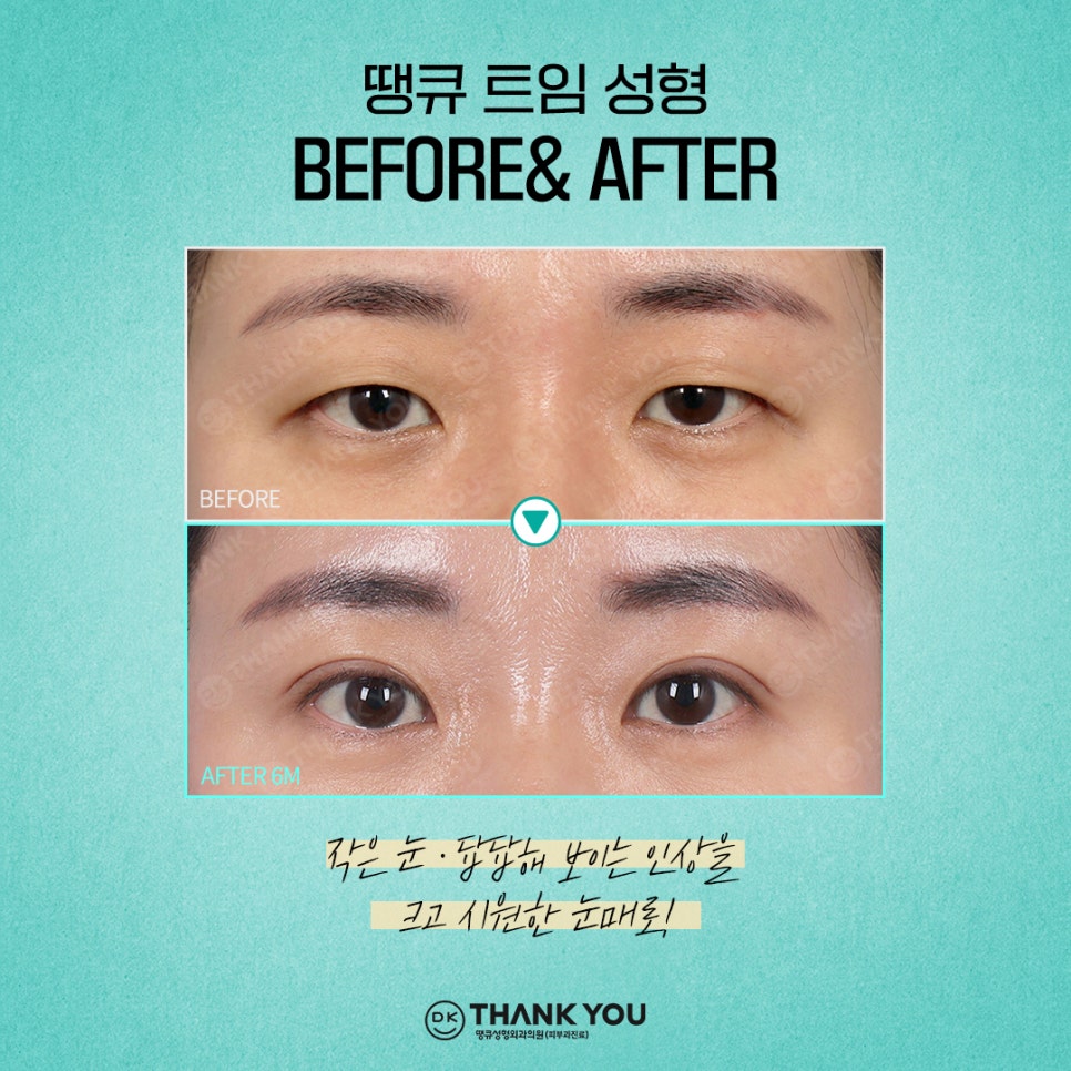 첫눈성형 후기 좋은 땡큐에서 만드는 예쁜 눈매💚 관련 이미지 6