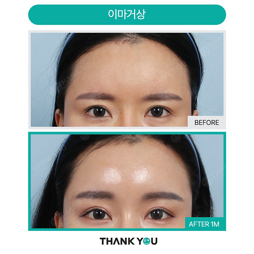 쌍꺼풀수술 없이 처진 눈 해결? [중년 이마거상/ 눈썹하거상술] 관련 이미지 5