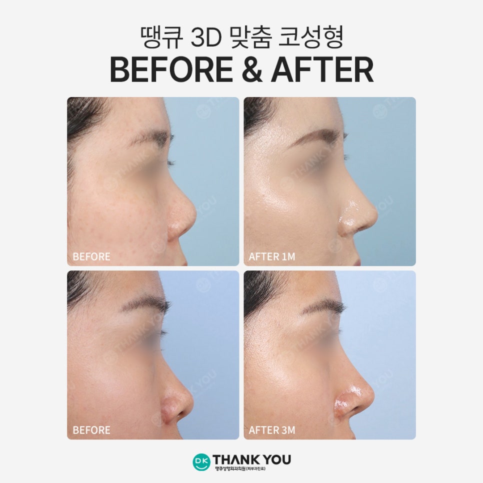 땡큐성형외과 권정우 원장, 코수술재료 관련 이미지 11