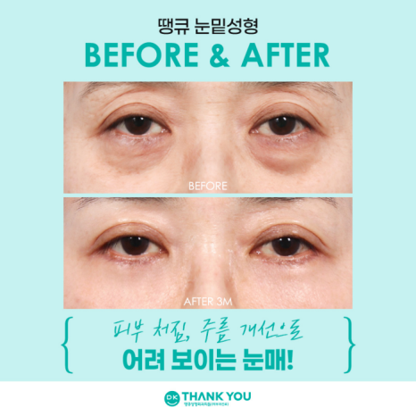 눈밑성형수술 만족도를 높이는 방법은? 관련 이미지 8