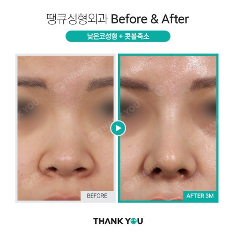복코 수술&뭉툭한 코 교정👃직원도 믿고 코성형하는 땡큐 관련 이미지 17