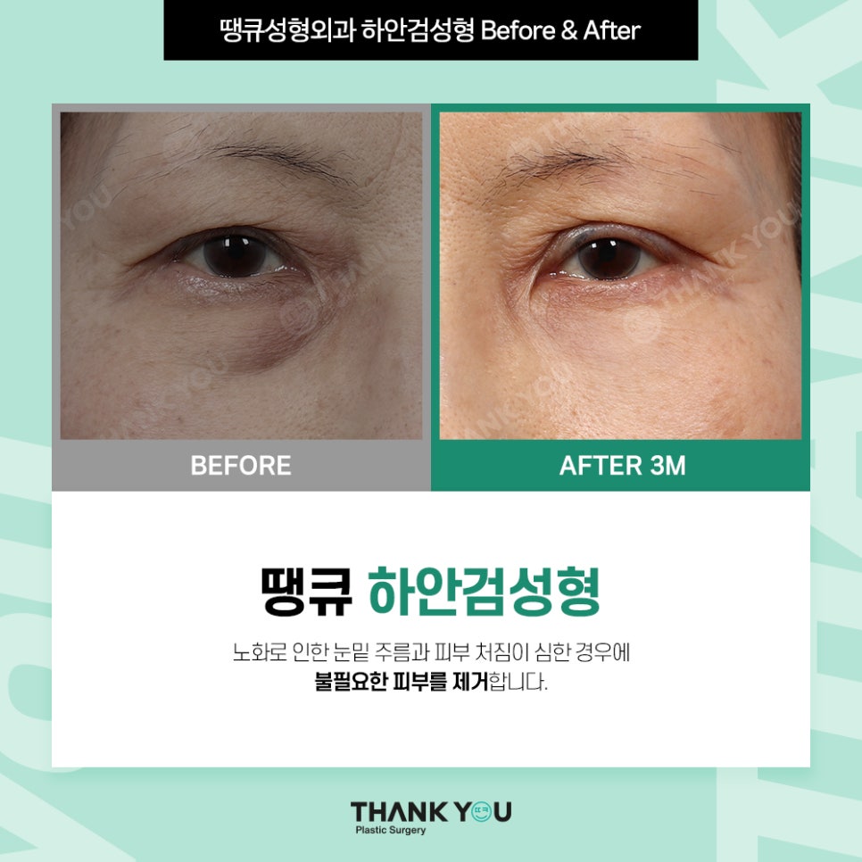 눈밑지 눈밑지방제거, 하안검 차이점은? (눈밑 비포&애프터) 관련 이미지 9