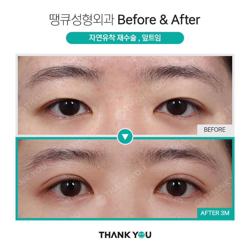 신논현역 성형외과에서 쌍수 전후 Check✨ 관련 이미지 4