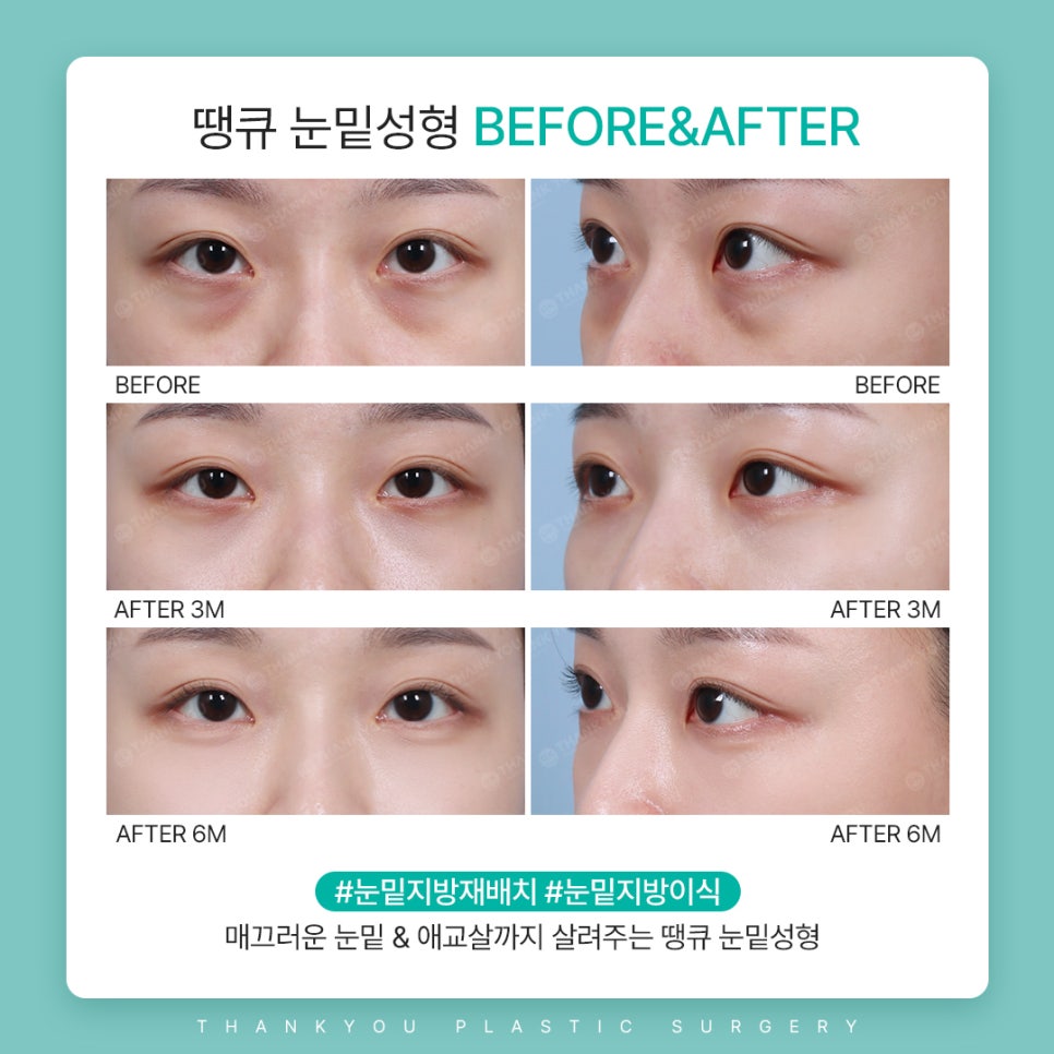 눈밑지방재배치수술만으로 볼륨이 부족하다면? 관련 이미지 7