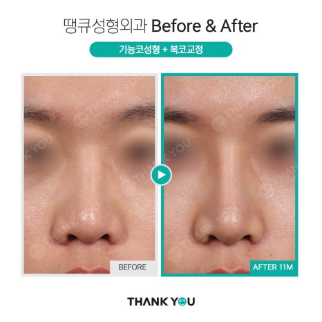 숨이 잘 안쉬어져요 실비코성형 비염도 기능코로 라인 커버! 관련 이미지 7
