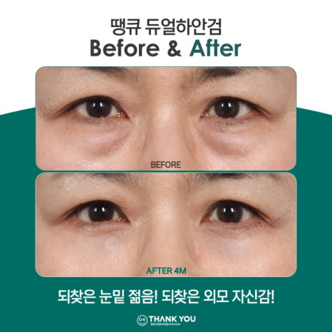 If You Want a Satisfying Difference Before and After Lower Blepharoplasty?! Thank You Dual Lower Blepharoplasty image 7