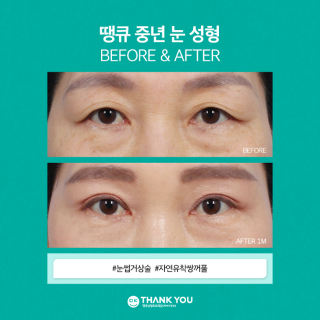 눈썹거상술 & 자연유착쌍꺼풀로 처진 눈꺼풀 효과적으로 개선! 관련 이미지 6