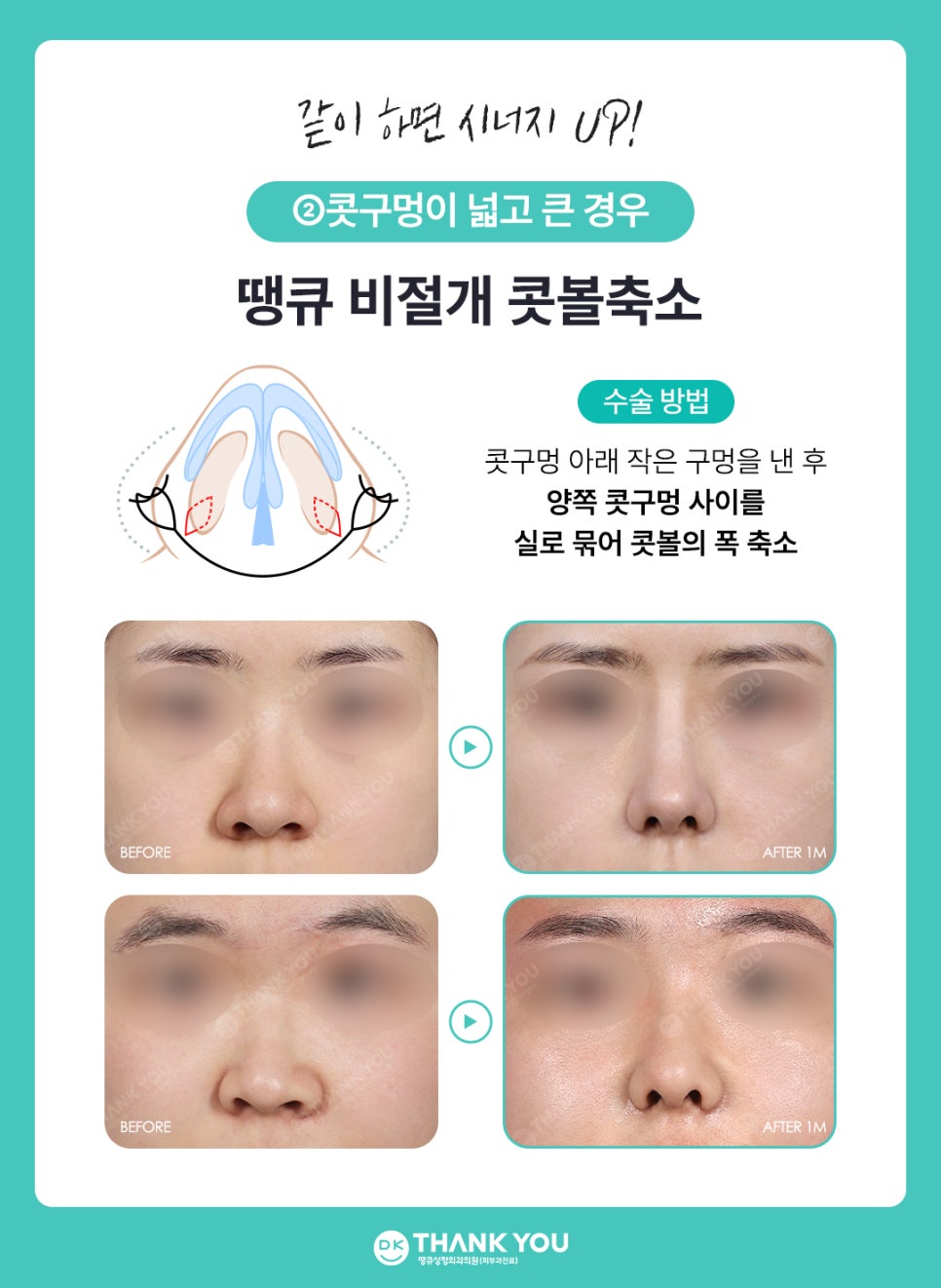 콧볼성형 찾는다면 여기! 땡큐 콧볼축소로 세련된 이미지 완성하기! 관련 이미지 10