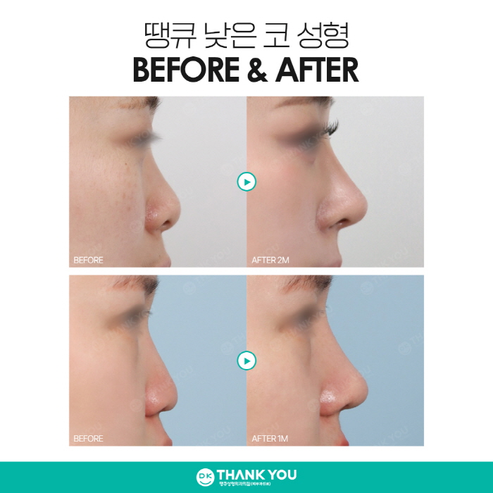 낮은코성형, 완성도 높은 결과를 얻고 싶다면 주목! 관련 이미지 7