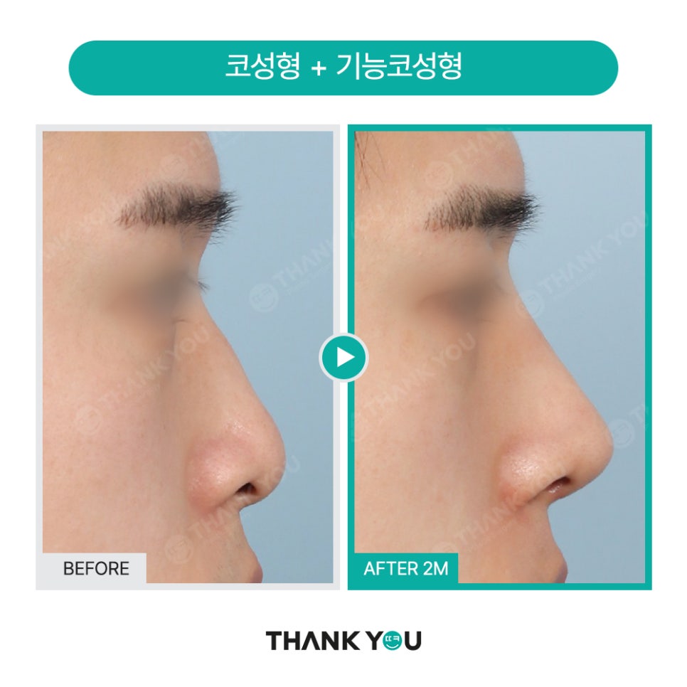 신논현역 성형외과, 남자 휜코성형, 매부리코 성공 포인트는? 관련 이미지 12