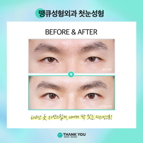 첫눈성형 성공을 위해, 눈수술 잘하는 곳 찾는 방법은? 관련 이미지 10