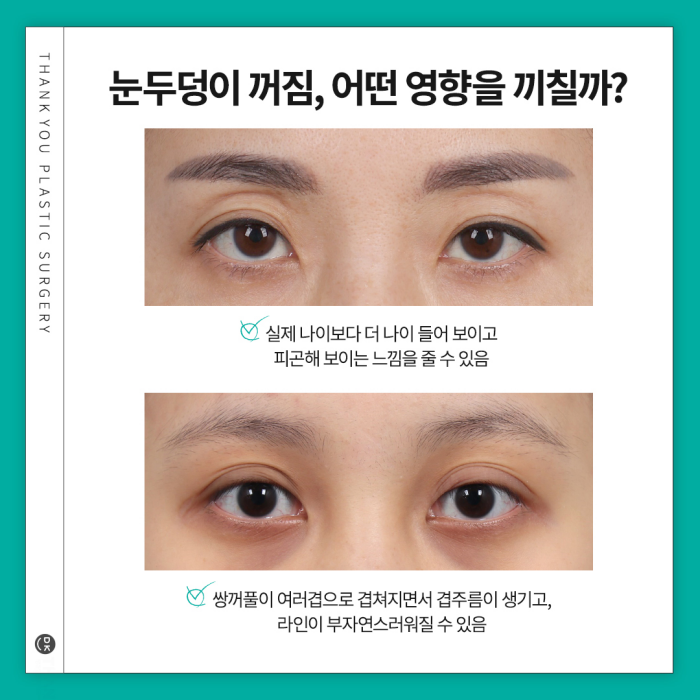 눈두덩이지방이식으로 피곤한 이미지 탈출! 생기있는 눈매 완성! 관련 이미지 3