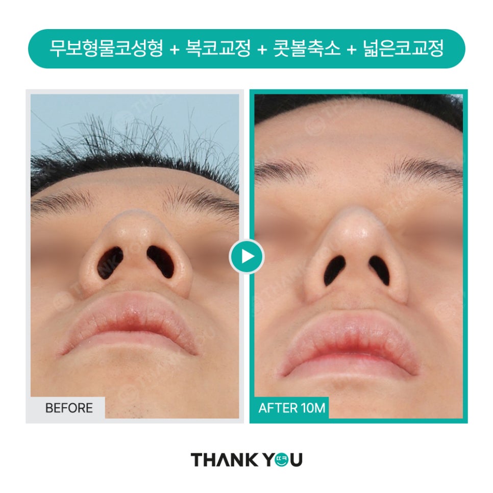 자가늑연골 코수술 장단점, 실리콘없이 무보형물 전후Check 관련 이미지 15