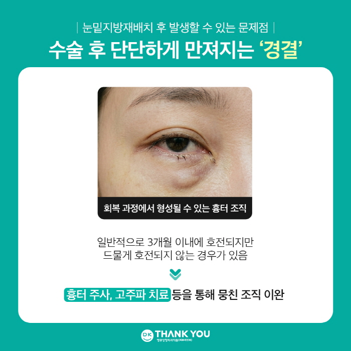 눈밑지방재배치 부작용 어떤 것들이 있을까? 관련 이미지 2