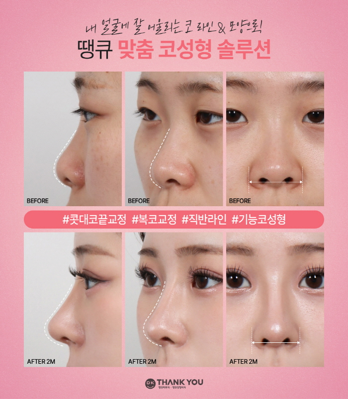 땡큐성형외과, 맥미걸 솔루션! 하비갑개수술 X 미용코, 기능&middot;미용 개선을 동시에! 관련 이미지 8