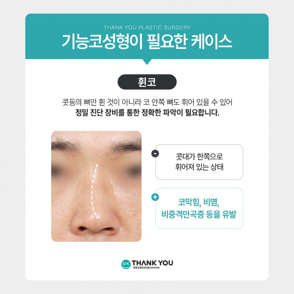 기능코성형, 비염수술코성형 유형별 수술법 알아보기 관련 이미지 4