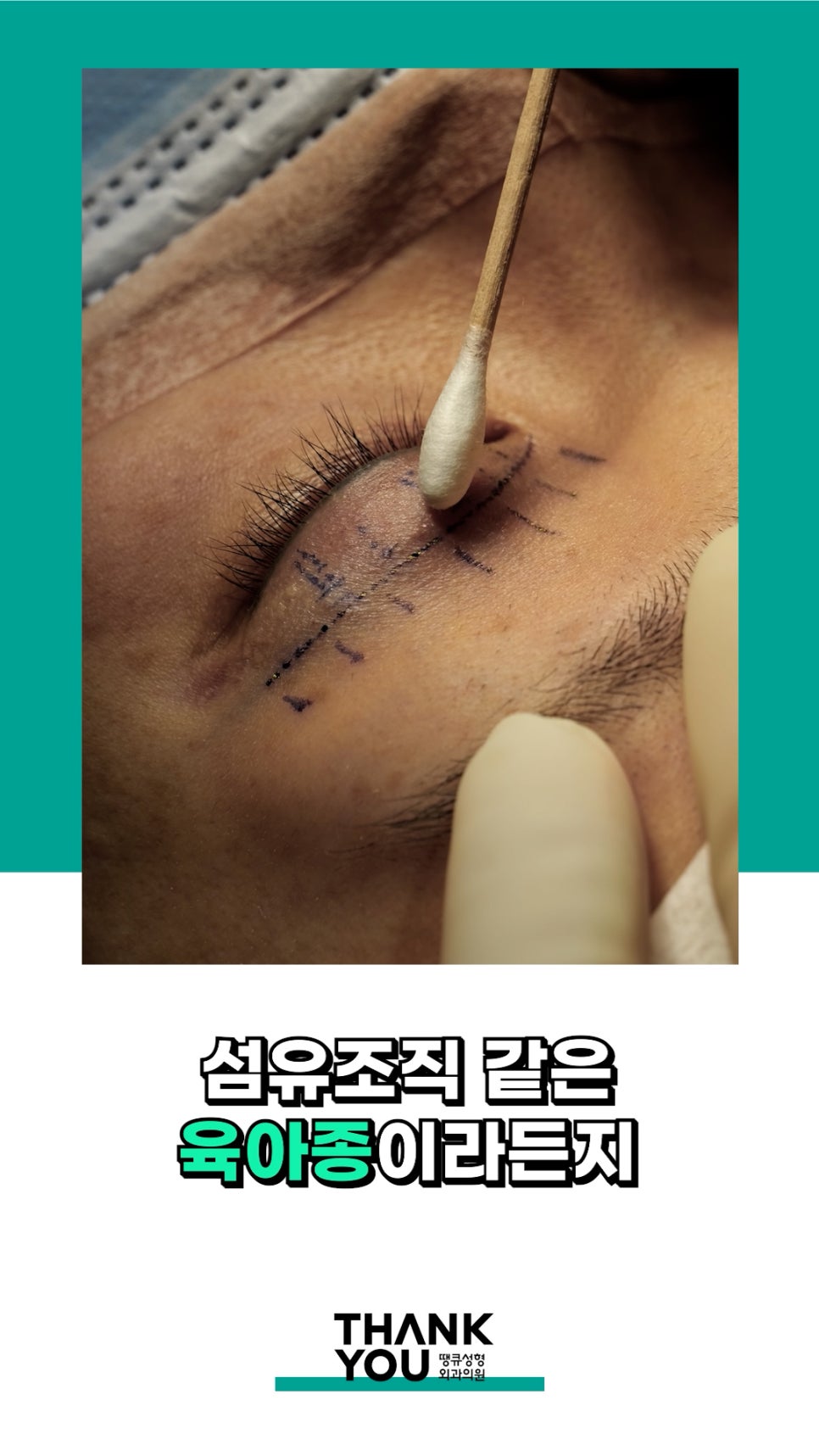 3번 눈재수술? 근데 실제거를 안했다고? 땡큐에서 전부 실제거! 관련 이미지 8