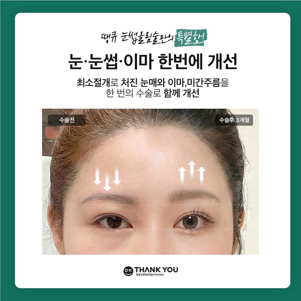 Improving Drooping, Tired-Looking Eyes in One Go with Forehead Lift Surgery! image 7
