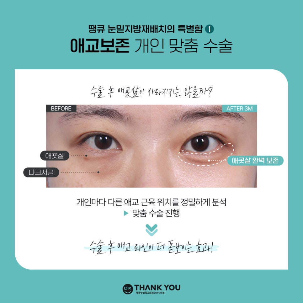 눈밑지방재배치잘하는병원 땡큐만의 특별한 노하우! 관련 이미지 3