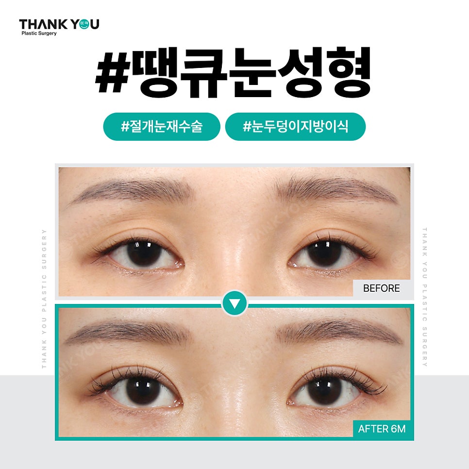 쌍꺼풀 라인 종류, 내게 맞는 쌍수랑 트임은?(인라인) 관련 이미지 5