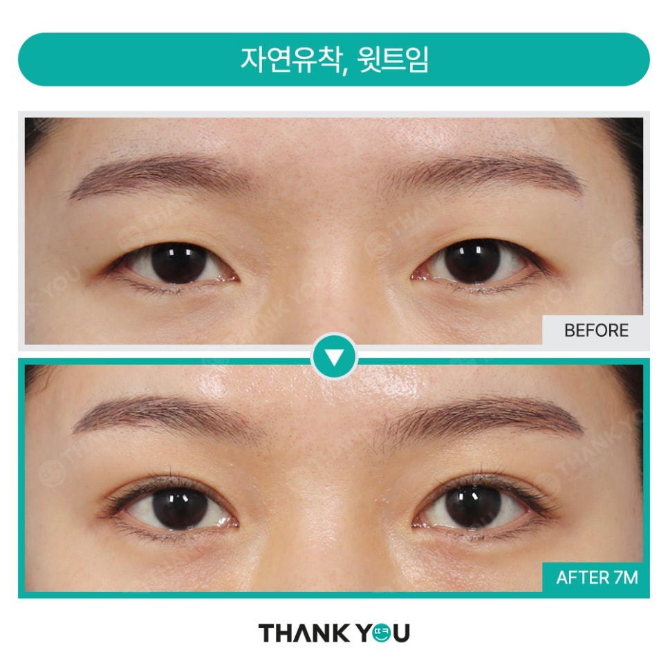 [비절개눈매교정+앞윗트임+눈밑지] 자고 일어났을 뿐인데 제니가?! 관련 이미지 22