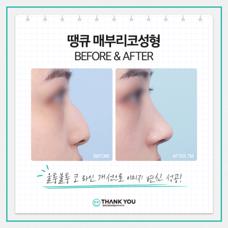 매부리코개선 맞춤 디자인으로 원하던 워너비 코 완성! 관련 이미지 9