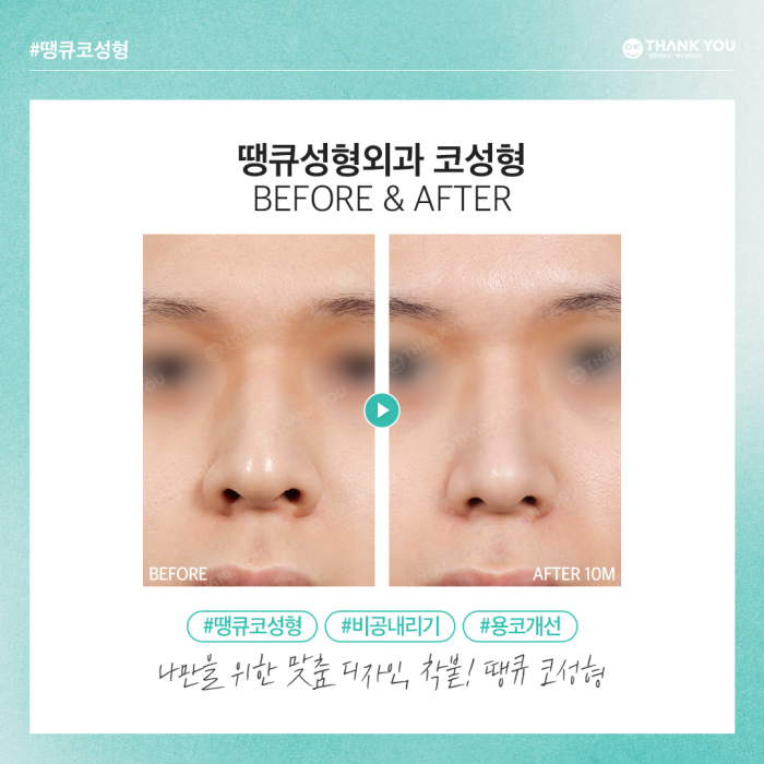 비공내리기로 용코교정하고 조화로운 코 만들기🍀 관련 이미지 9