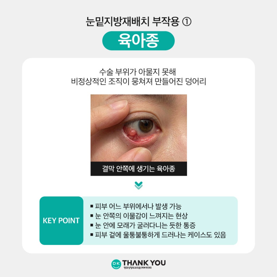 Under-Eye Fat Repositioning Side Effects: What Are the Causes and Treatment Methods?! image 2