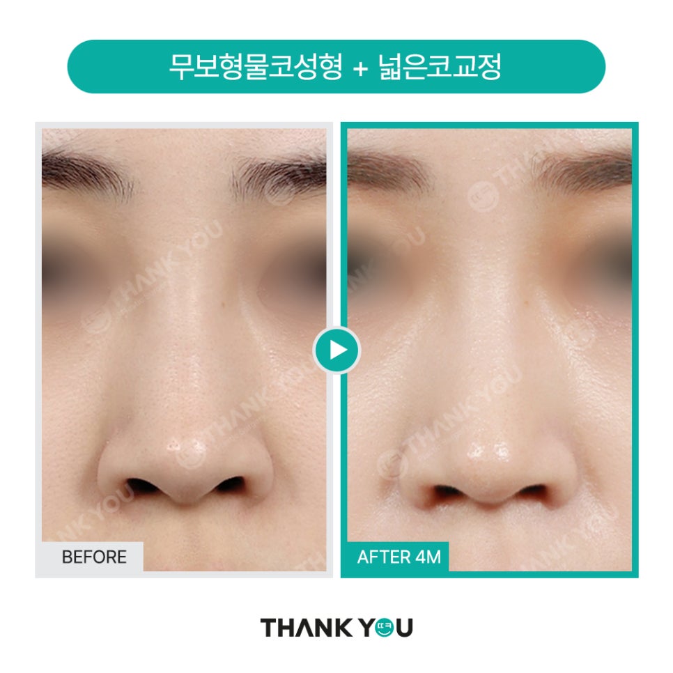 넓은코, 큰코성형 매부리코교정 찾는다면? 관련 이미지 10