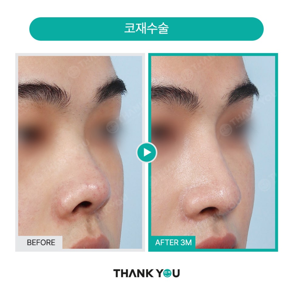 신논현역 성형외과, 남자 휜코성형, 매부리코 성공 포인트는? 관련 이미지 9
