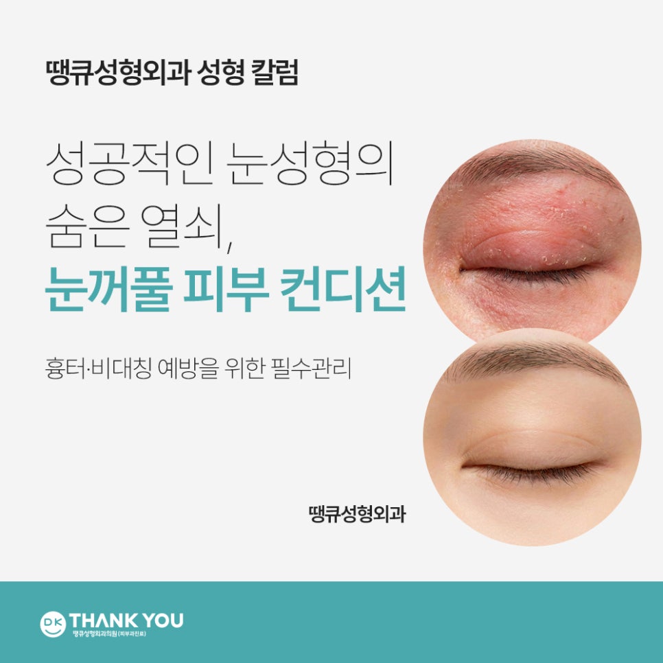 [의학정보]성공적인 눈 성형을 위한 관련 이미지 1