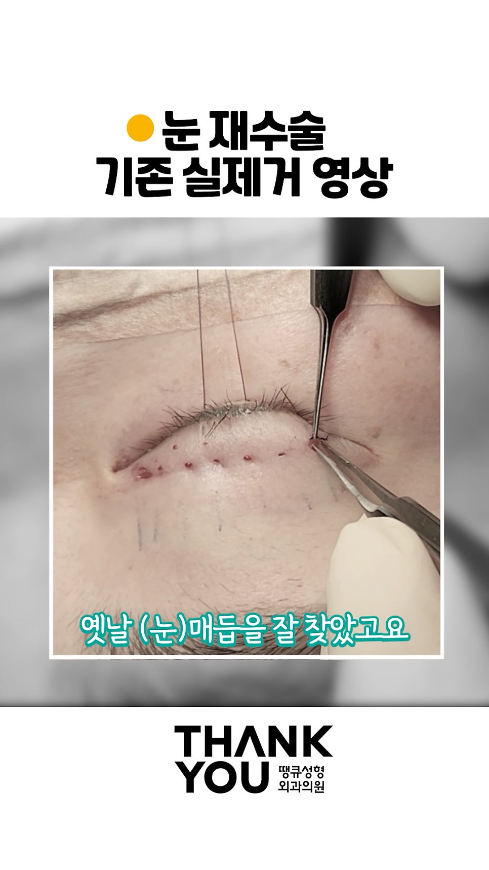 쌍수 풀기 (재수술전 실풀기+ 눈재수술 전후) 관련 이미지 5