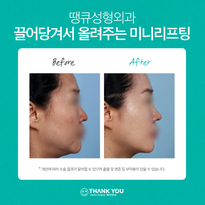미니리프팅, 탄력과 주름을 동시에 개선하는 동안시술🤗 관련 이미지 12