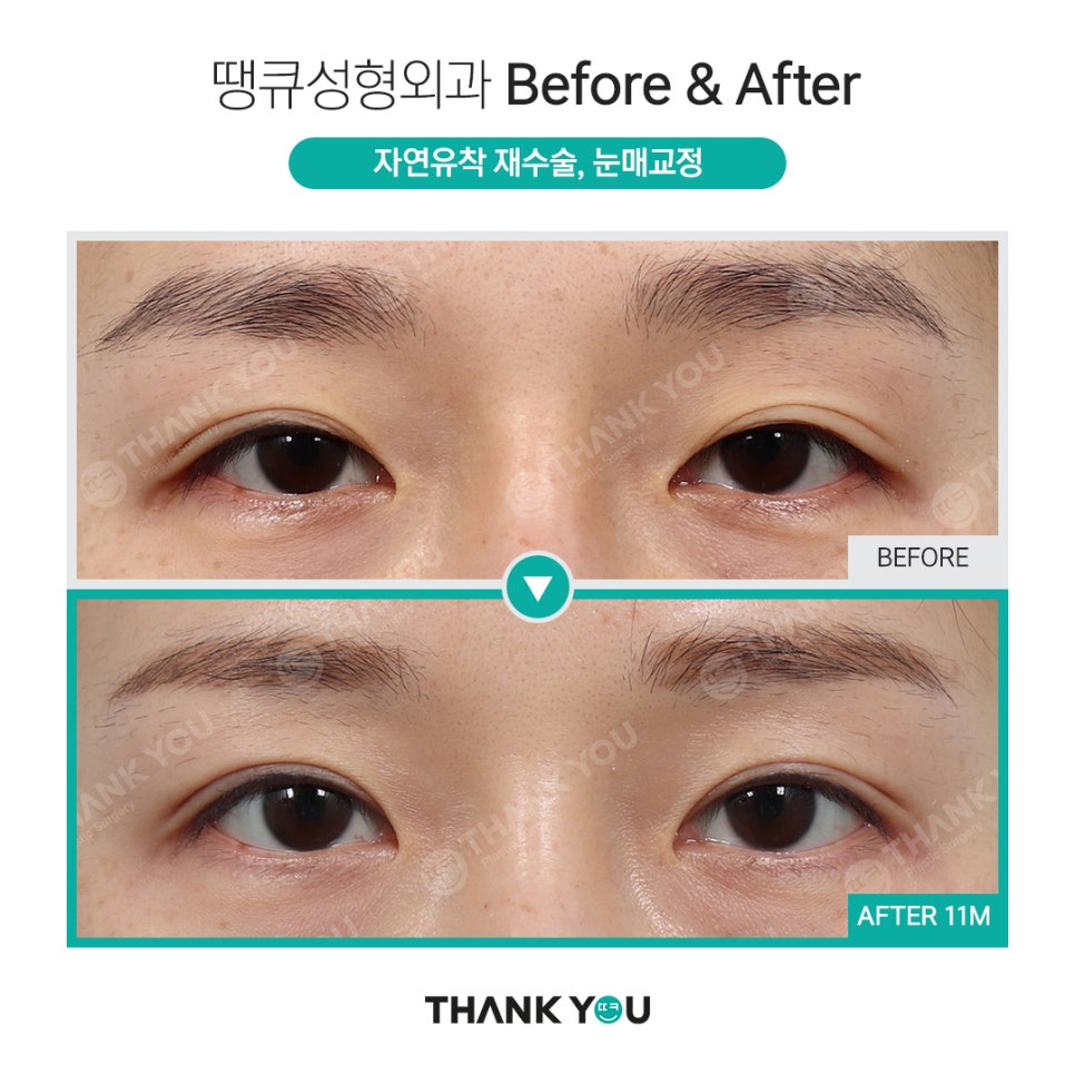눈매교정 전후? 수술 전후사진으로 체크해요 관련 이미지 4