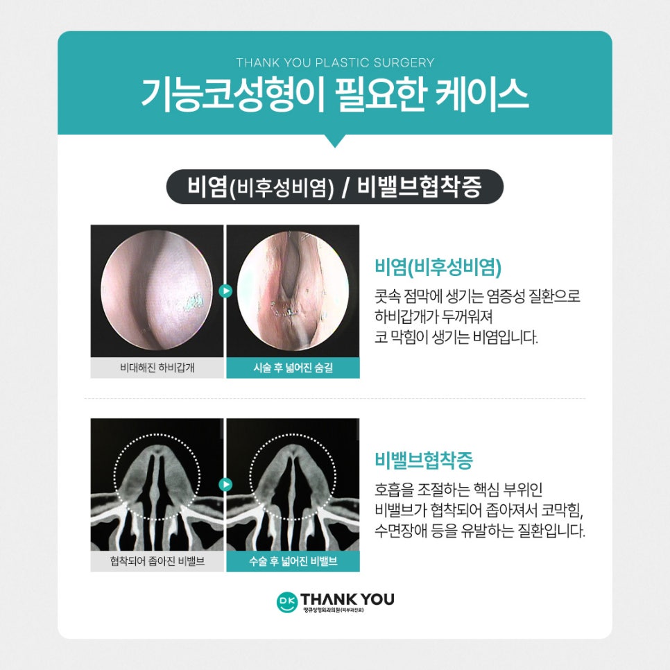 기능코성형, 비염수술코성형 유형별 수술법 알아보기 관련 이미지 6