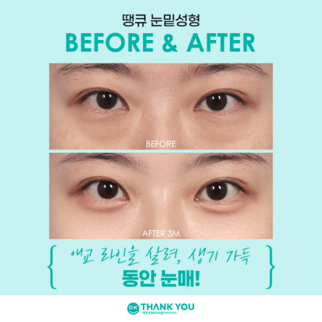 눈밑성형수술 만족도를 높이는 방법은? 관련 이미지 10