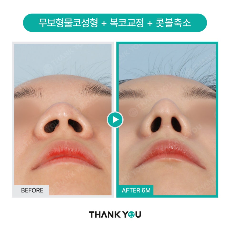 이런 코는 무조건 성공?! 코성형 성공 유형 관련 이미지 8