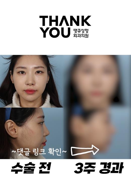 강아지상 여자, 눈성형과 코성형시 체크 포인트 관련 이미지 7