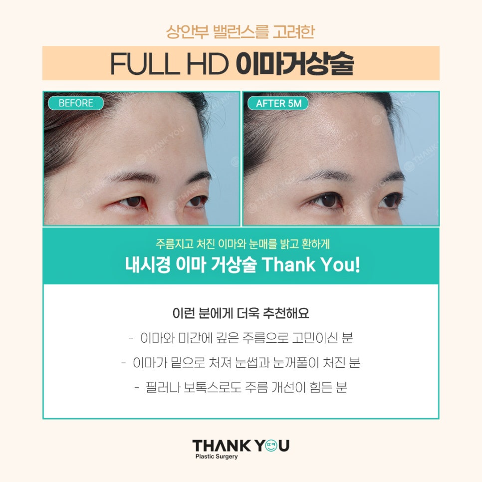 이마 주름이 심하다구요? "이마거상술 내시경" 이란? 관련 이미지 3