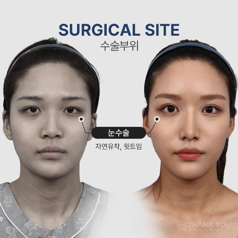 눈코성형 같이 하고싶다면? (자연유착 윗트임+콧불축소) 관련 이미지 3