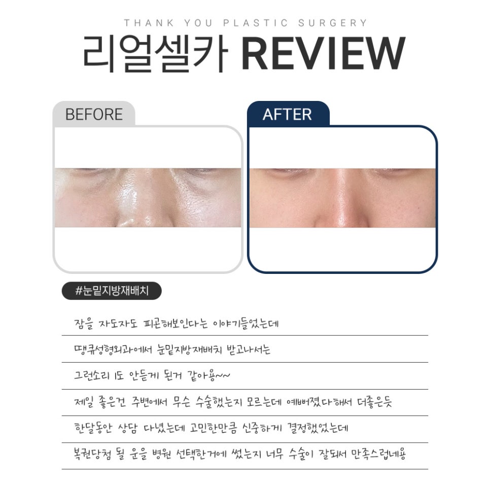 땡큐 다크서클 수술&눈밑지방재배치 리얼셀카  𝐑𝐄𝐕𝐈𝐄𝐖 관련 이미지 5