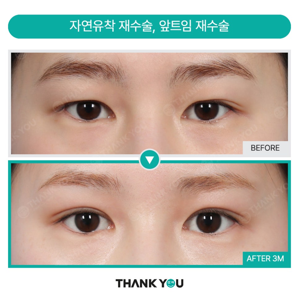 고양이 눈매 완성! (ft.눈매교정+앞,뒤,밑트임+눈밑지) 관련 이미지 16