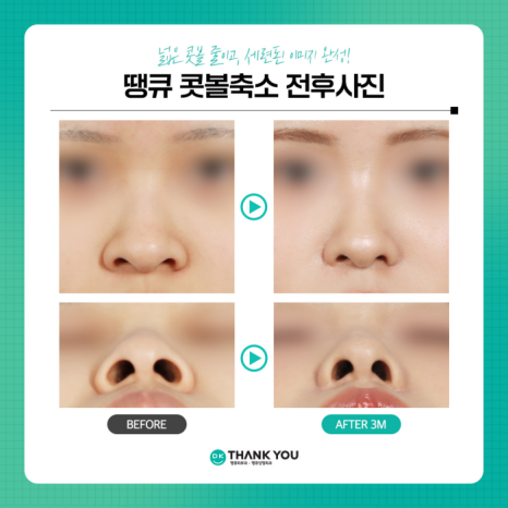 콧볼축소술로 촌스러운 이미지 만드는 콧볼줄이기! 관련 이미지 8